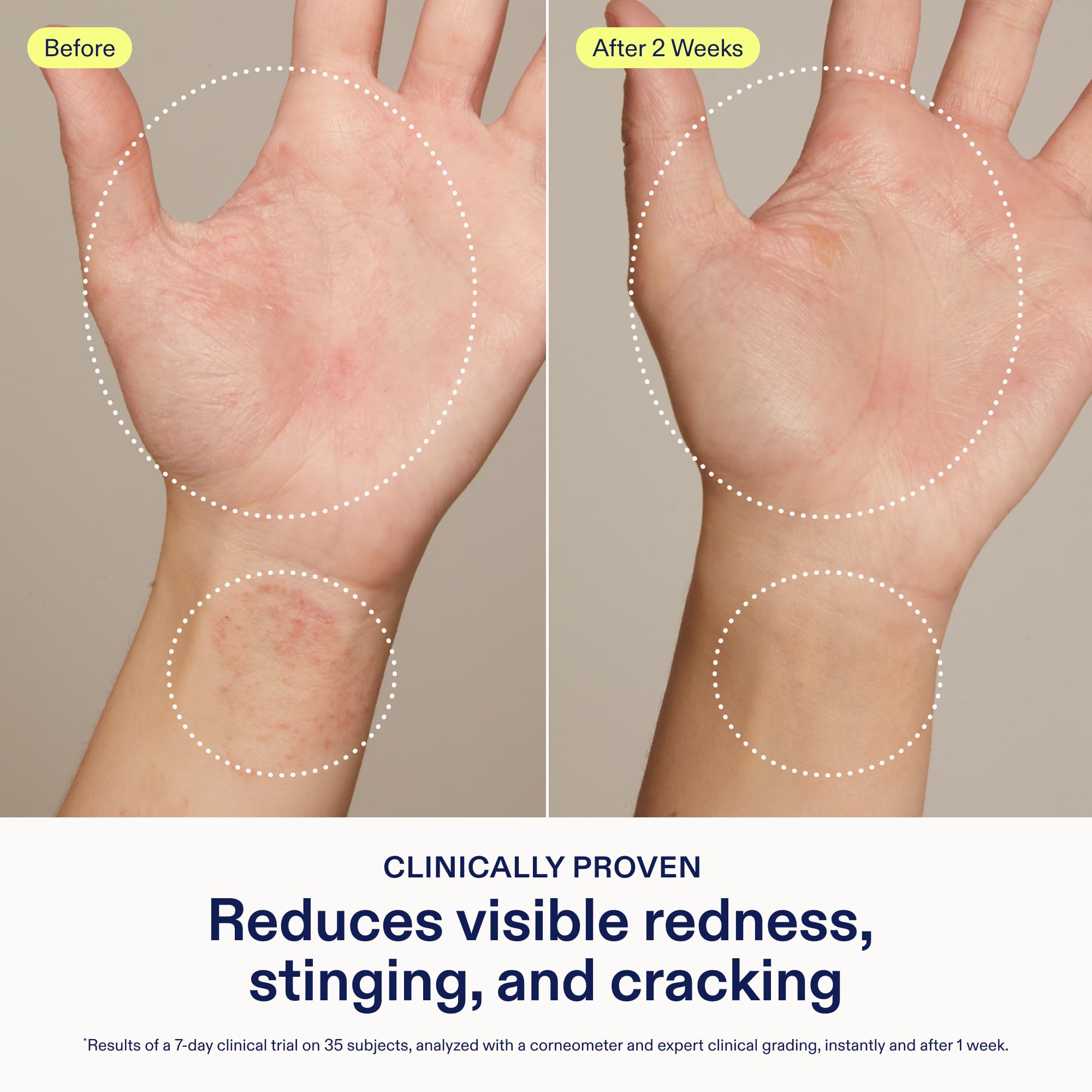 Skinfix Crème Mains Relief - application facile sur les mains pour apaiser