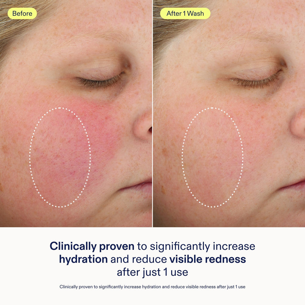 Mousse abondante Skinfix sur visage, douceur instantanée après rinçage.