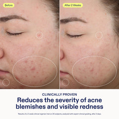 Skinfix 2% BHA Spot Treatment – texture gel légère sur la peau.