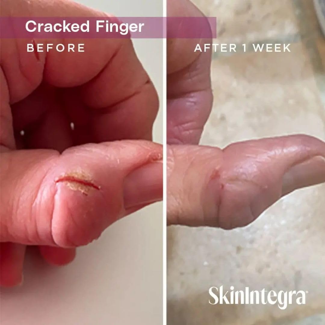 SkinIntegra soin des sutures et cicatrices post chirurgie sur les pieds.