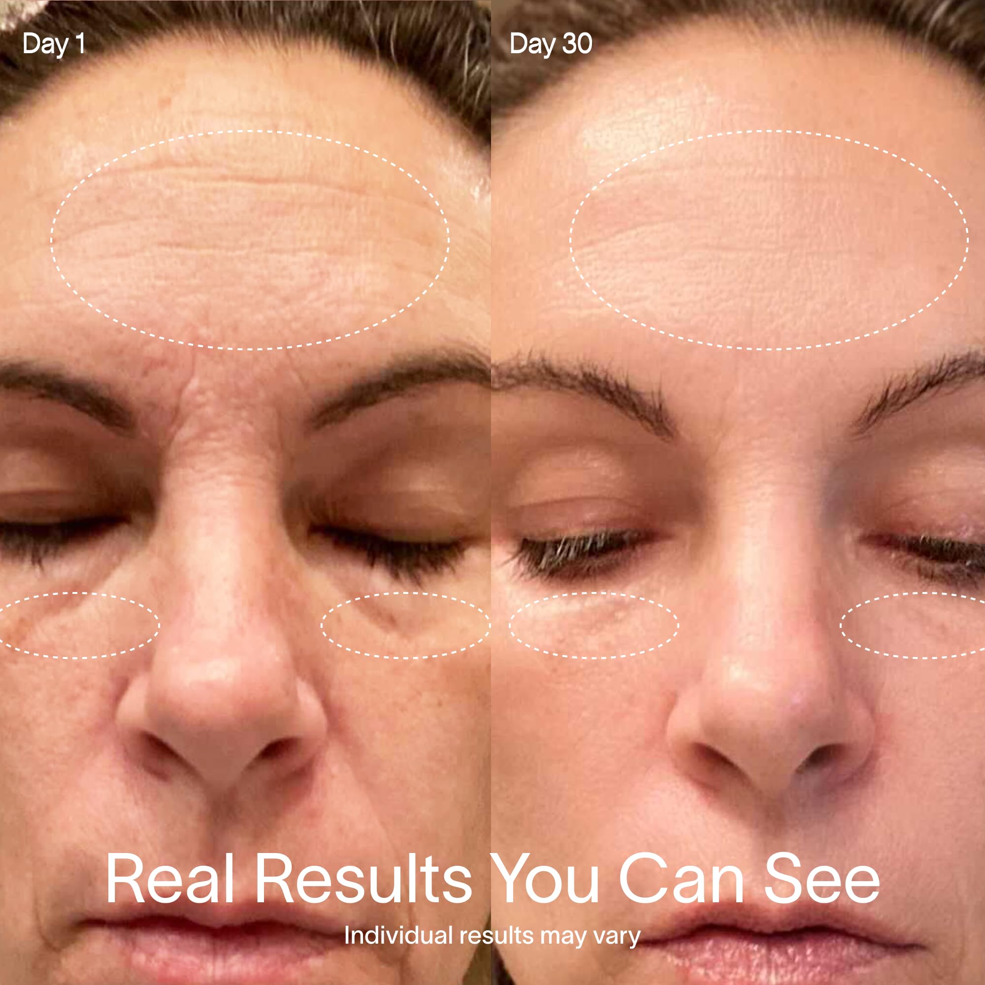 Solawave zones visage cibles pour une application précise