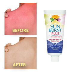 Sunburnt Plus Gel avec Lidocaïne – Apaisement potentiel après exposition solaire.