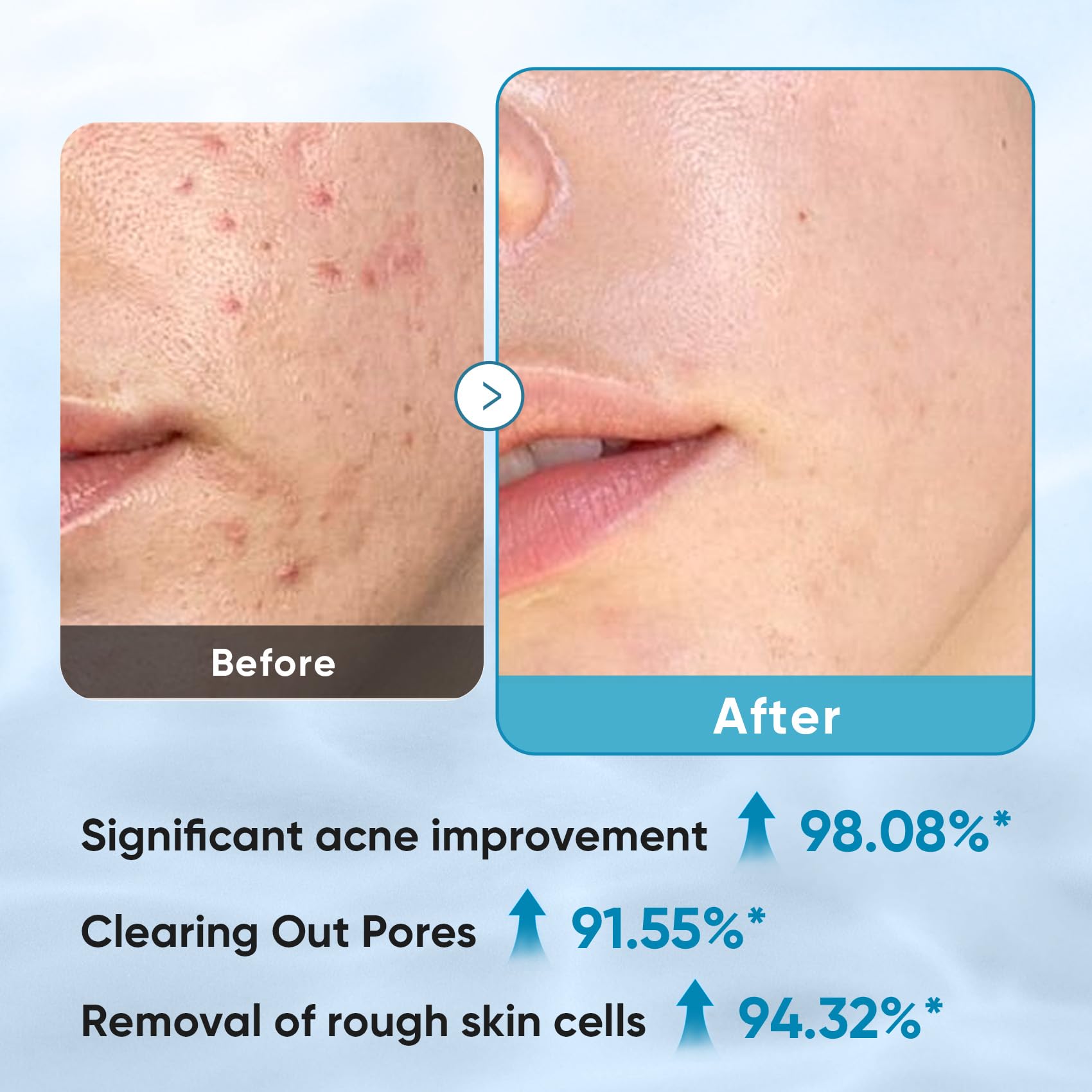 Tampons Elvira avec acide salicylique 2% aident à nettoyer les pores.