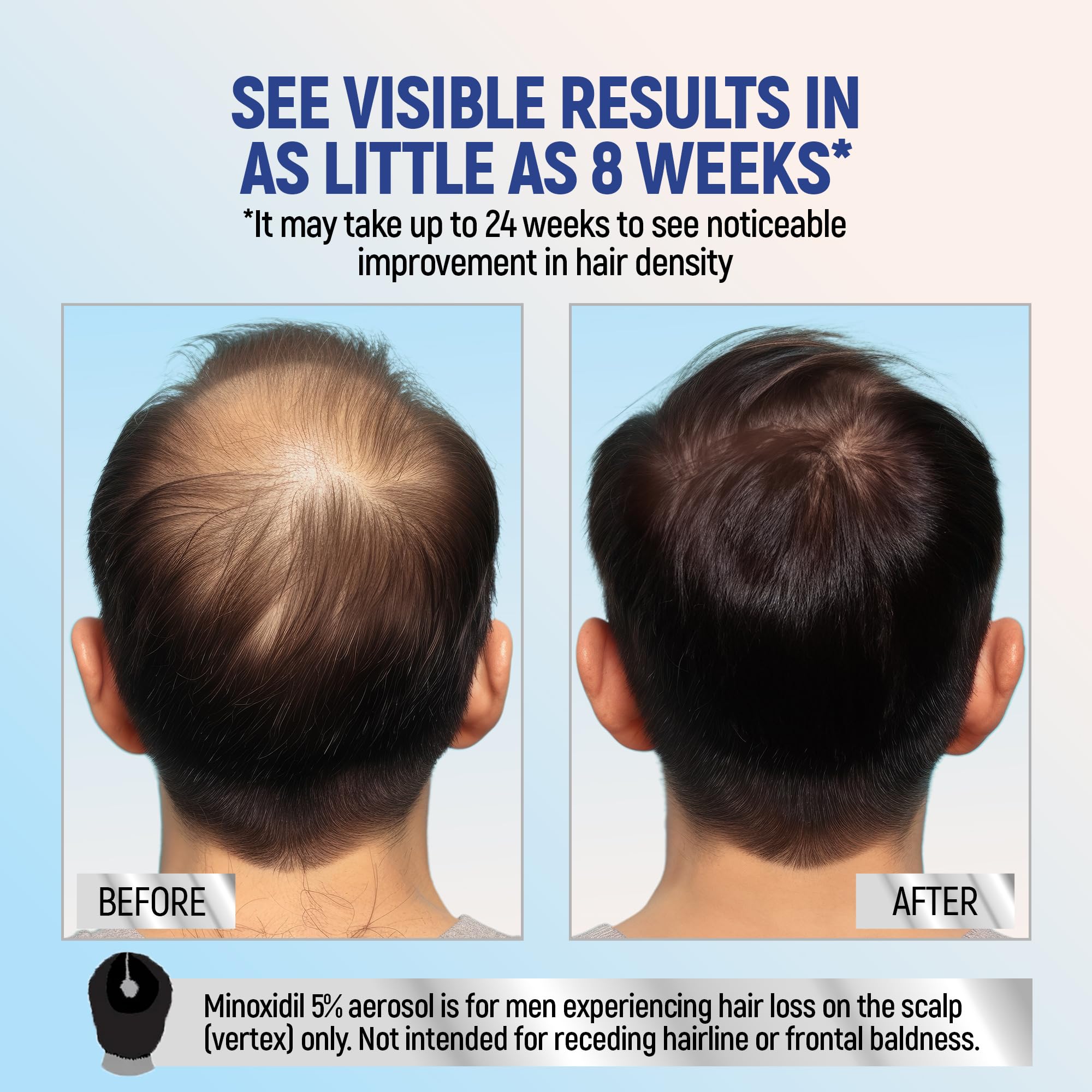 TARO Minoxidil flacon-aérosol : solution pratique prête à l’emploi.