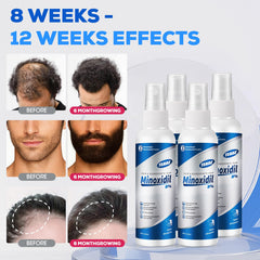TEADZ Minoxidil application quotidienne: routine simple matin et soir pour un cuir chevelu sain.