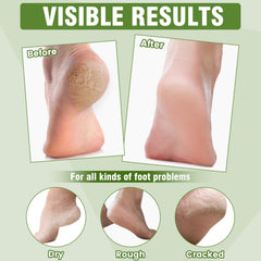 TEAWOO masque-pieds application rapide en 15 minutes pour soins à domicile.
