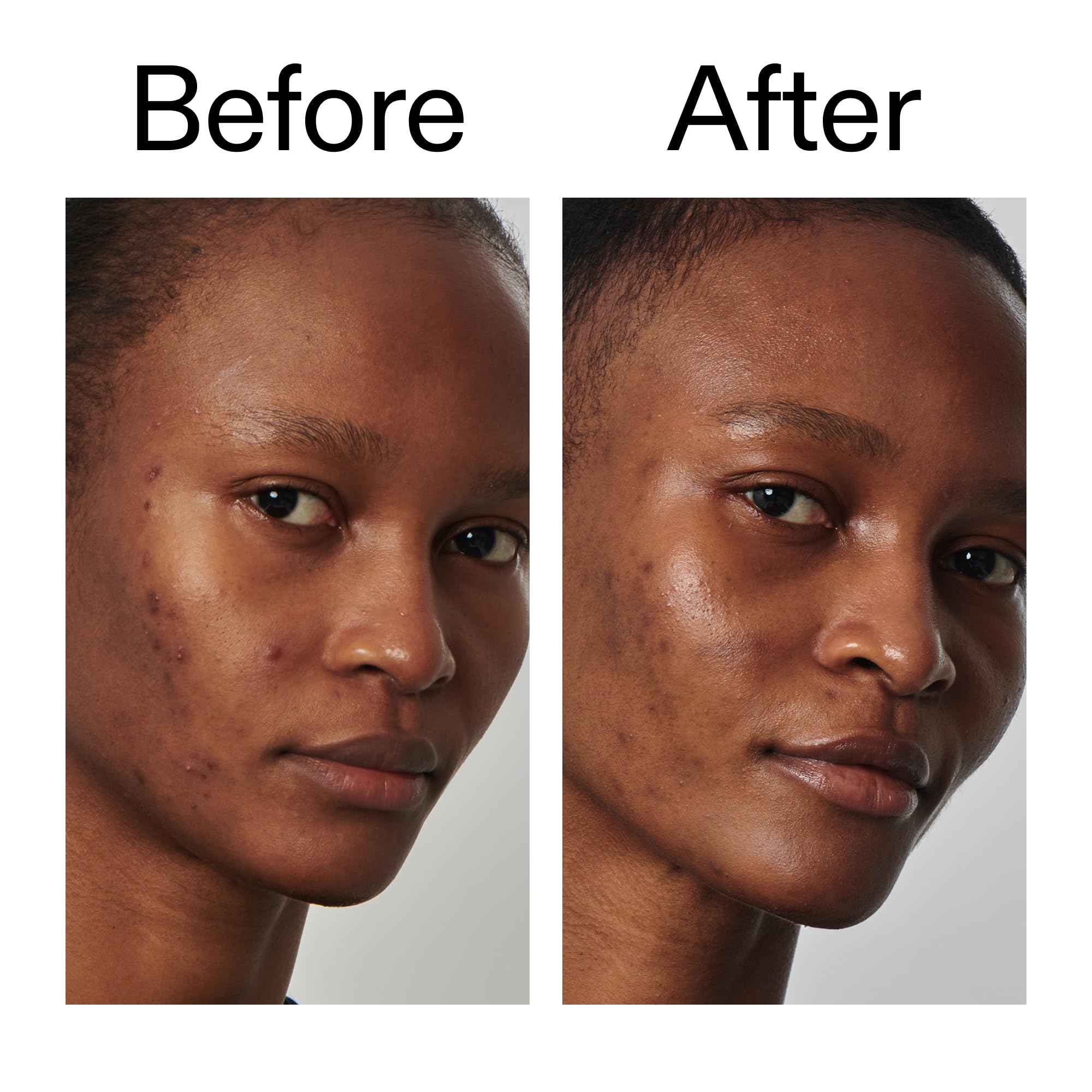 Ingrédients clés Niacinamide 20% et actifs pour l’équilibre de la peau.