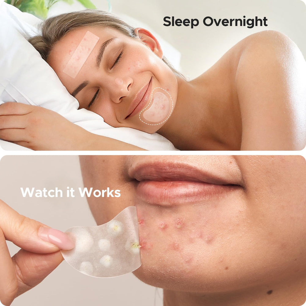 Coffret TKTK 280 patchs hydrocolloide visage.