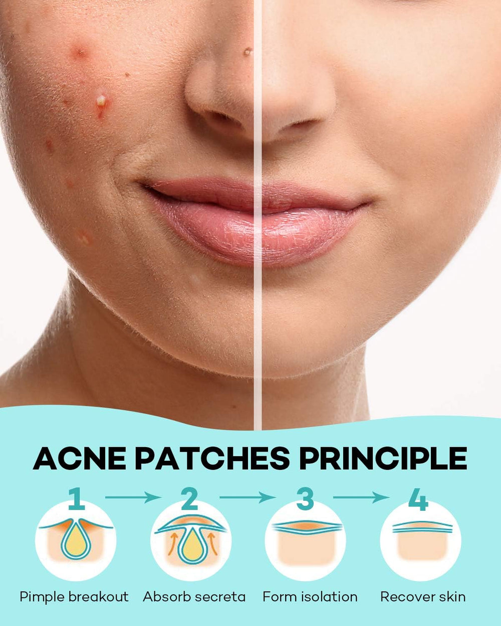 Pansements anti-acné TKTK, esthétique discrète et possibilité de maquillage léger.