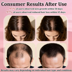 Vaporisateur Minoxidil 5% de TNEGHC, séchage rapide sans résidu