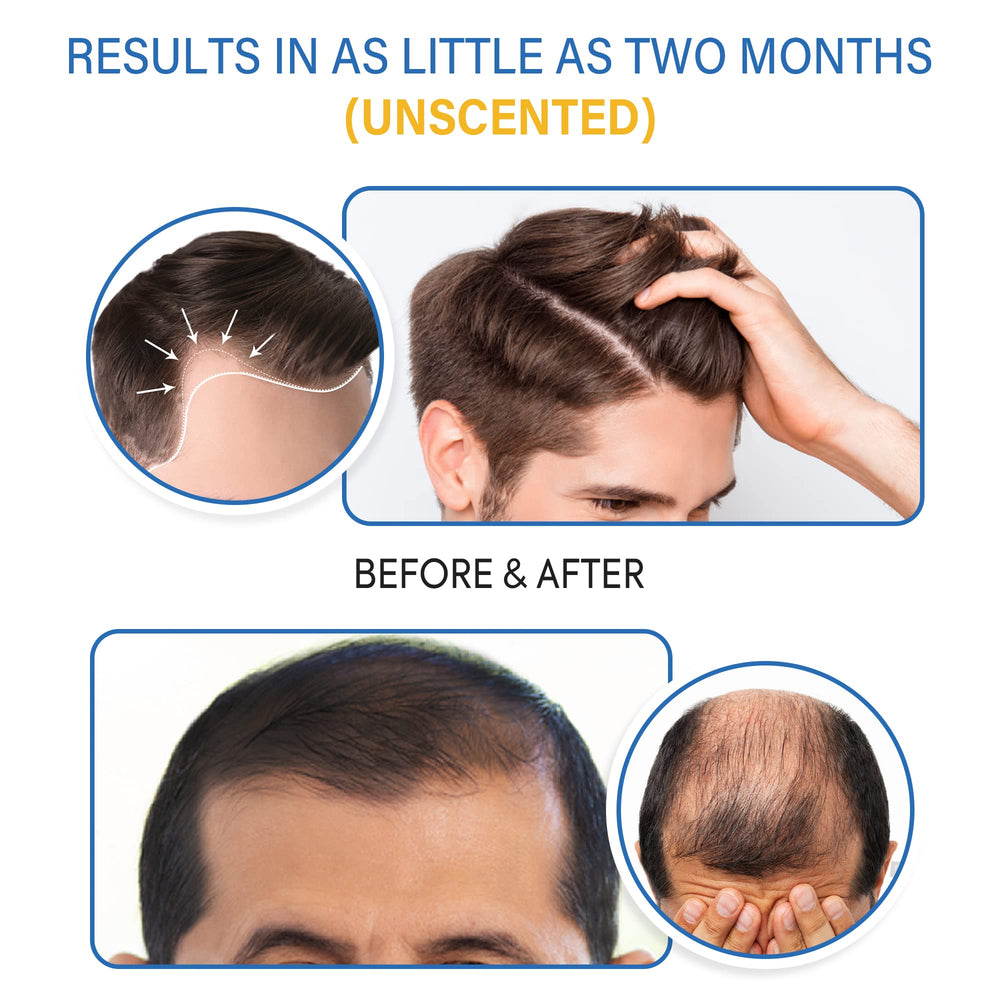 Tomum Minoxidil Mousse – soutien de la ligne frontale pour plus de densité