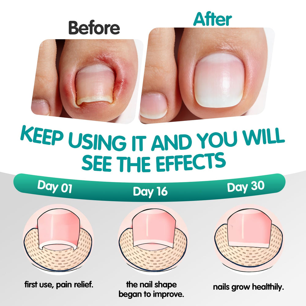 ToeRelix – design mince et respirant s’ajuste près de l’ongle sans encombrement.