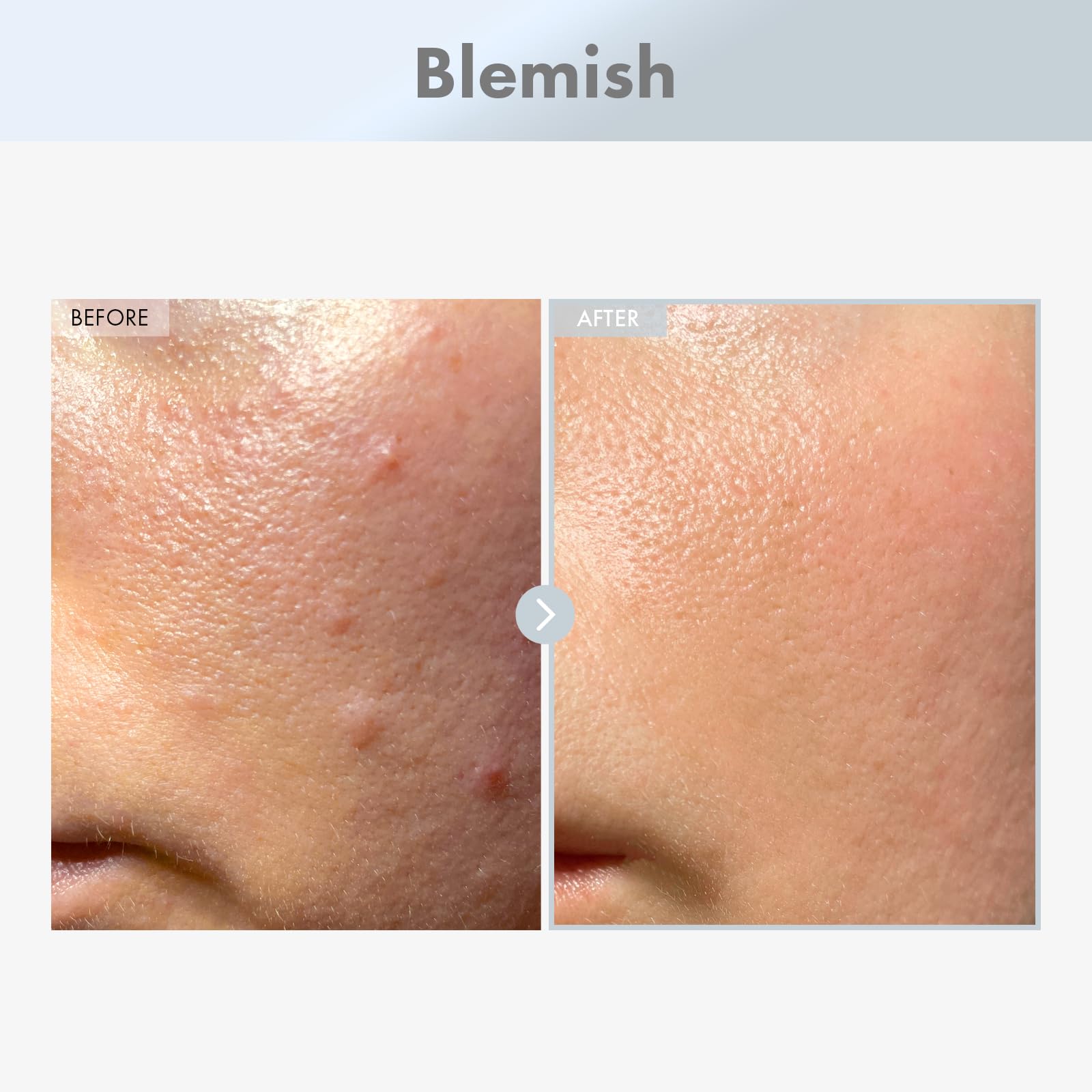 Gouttes Niacinamide 15% TOSOWOONG – application précise pour texture plus lisse.