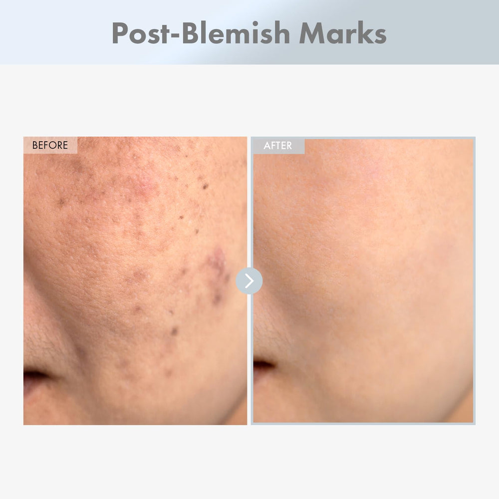 Texture peau améliorée avec le sérum Niacinamide TOSOWOONG – atténuation des rugosités.
