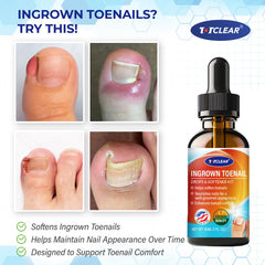 Totclear gouttes-assouplissantes-ongle-incarne : formulation légère pour adoucir l’ongle incarné.