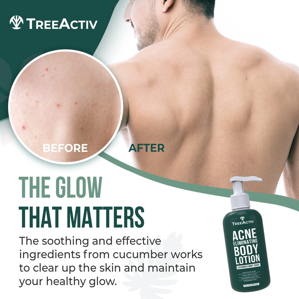TreeActiv lotion antiacné, absorption rapide et confort durable sur la peau.