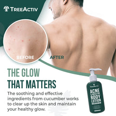 TreeActiv lotion antiacné, absorption rapide et confort durable sur la peau.