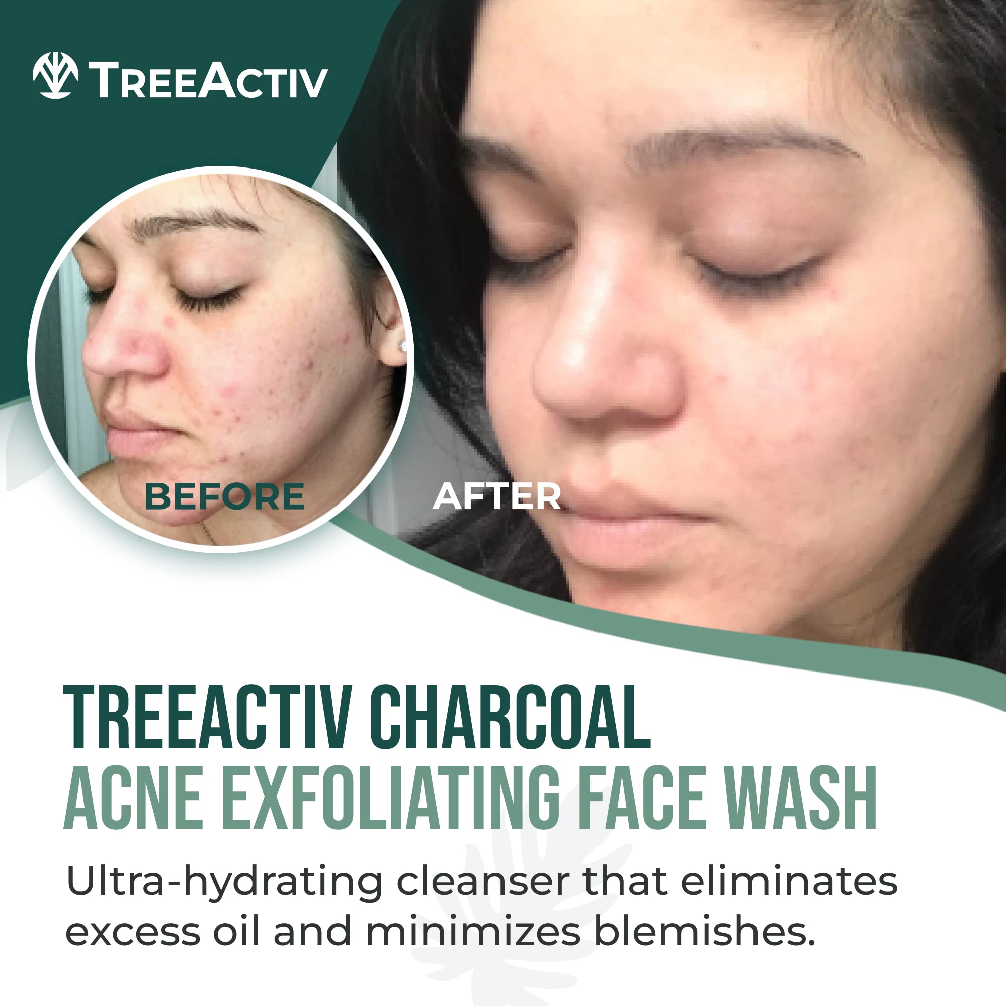 TreeActiv mousse charbon acné : texture légère qui nettoie sans dessécher