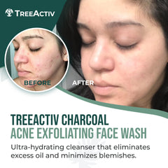 TreeActiv mousse charbon acné : texture légère qui nettoie sans dessécher