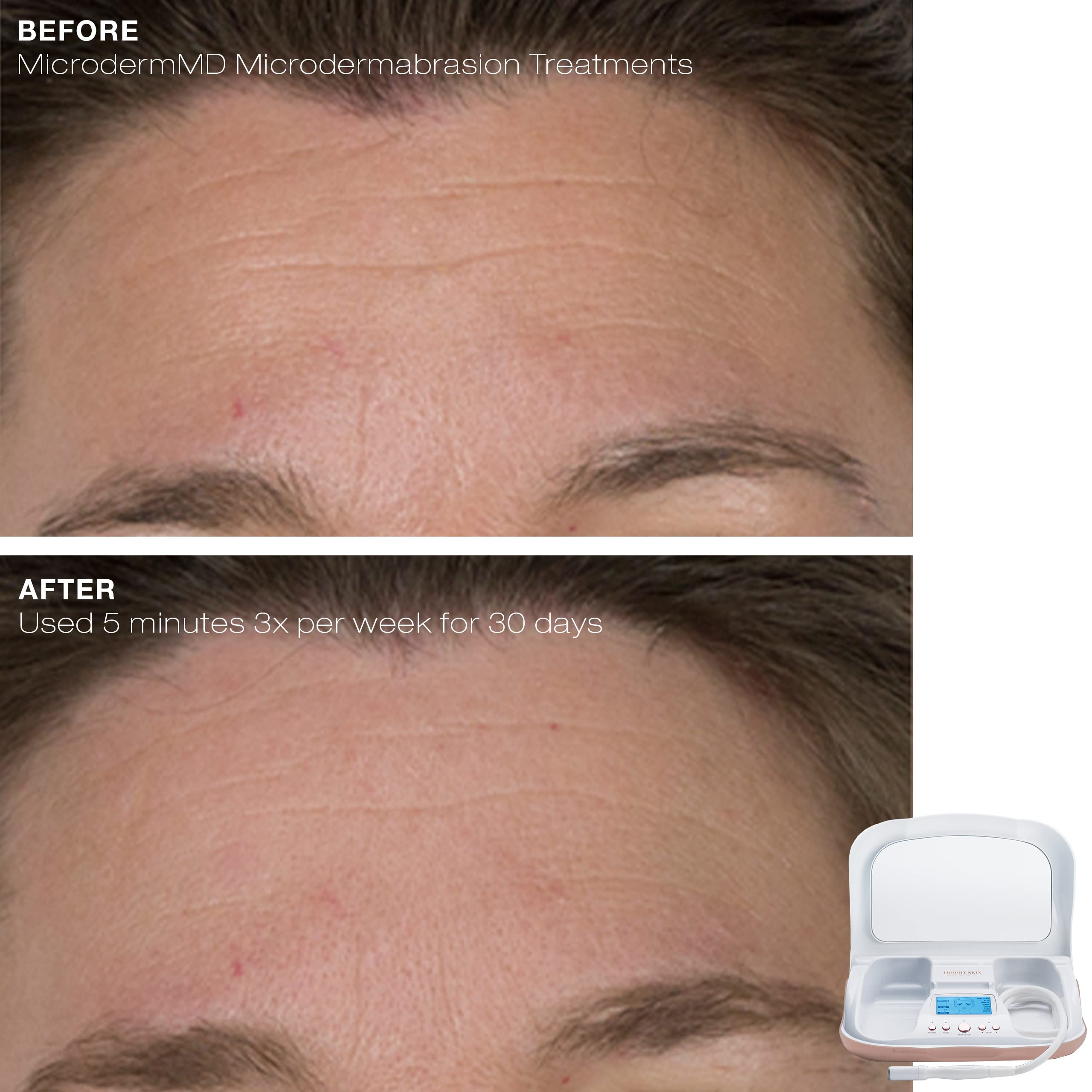 Kit de soin visage à domicile Trophy Skin MicrodermMD pour une routine complète.