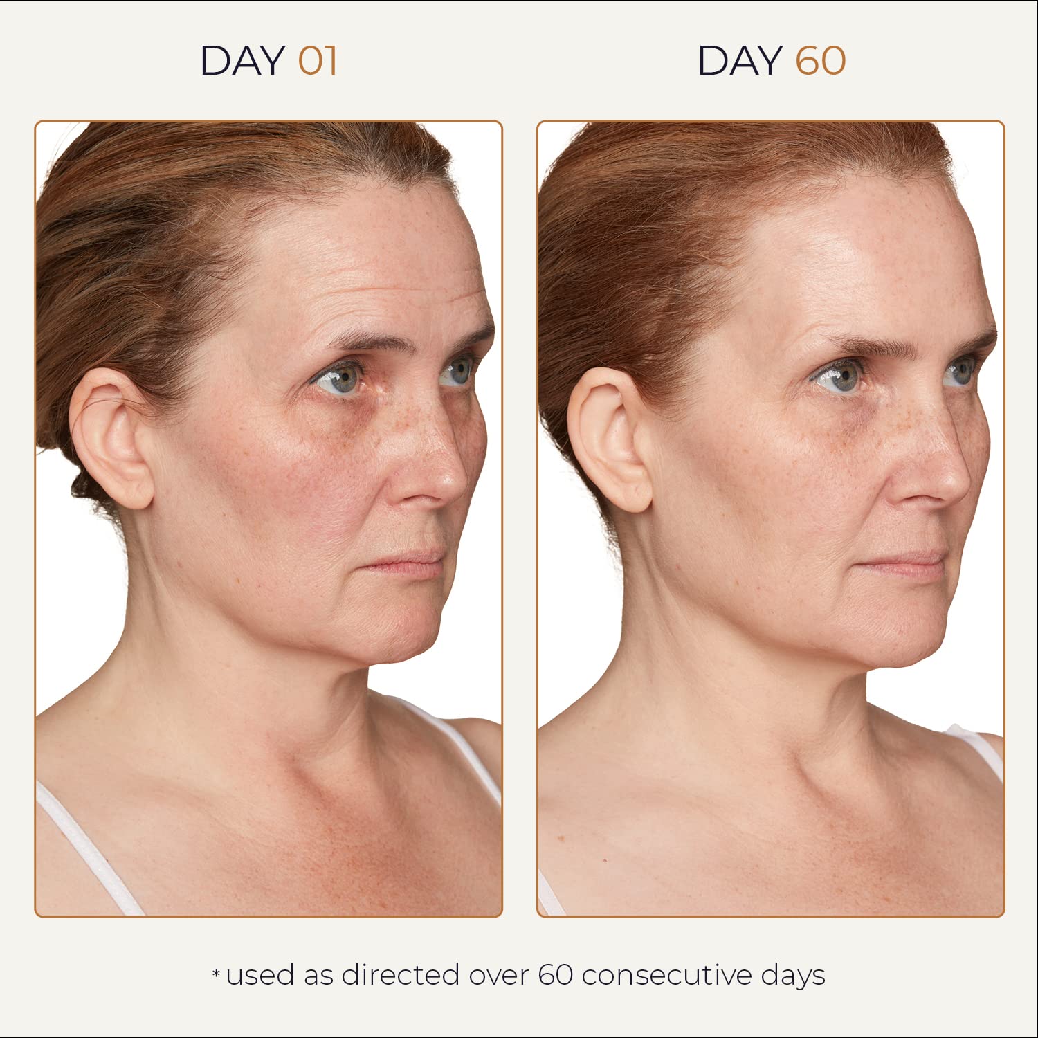 Spot Check sur zones d'hyperpigmentation visibles, amélioration potentielle.