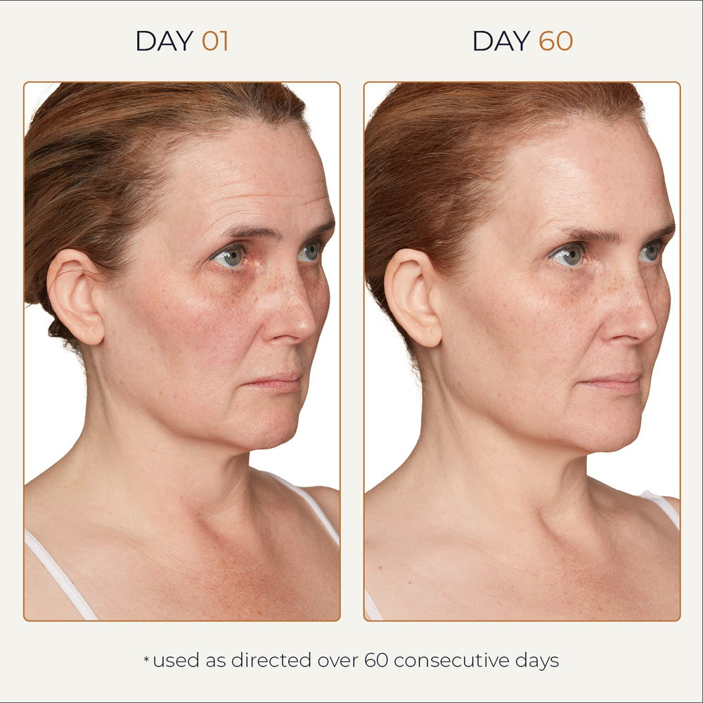 Spot Check sur zones d'hyperpigmentation visibles, amélioration potentielle.