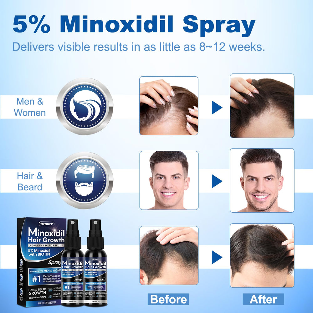 Zone capillaire clairsemée avec Tuymec Minoxidil 5% peut aider à densifier.