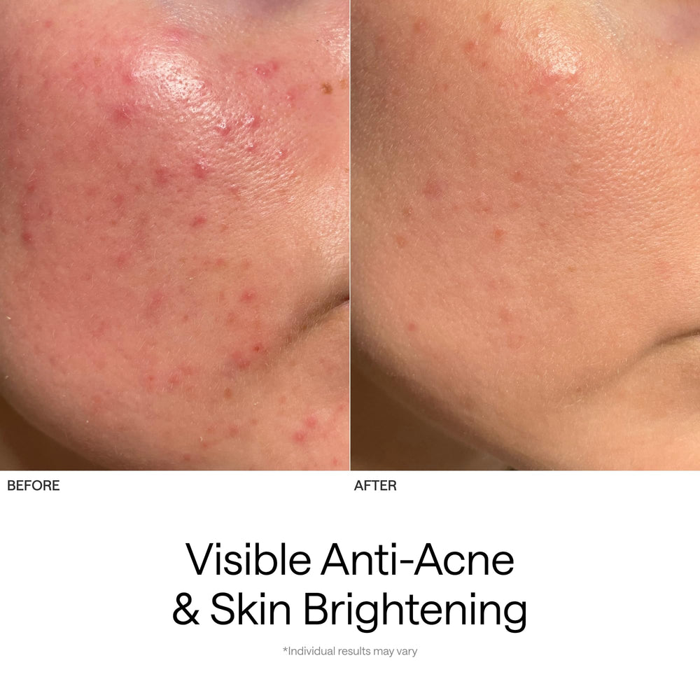 Ulike ReGlow Lite - lumière mixte rouge et bleu pour le renouvellement cutané.