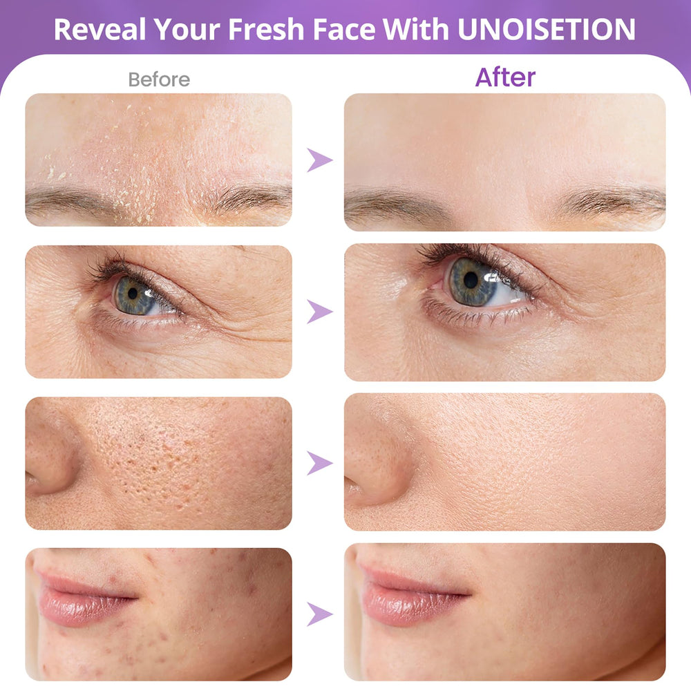 UNOISETION microdermabrasion au diamant, utilisation simple guidée avec résultats visibles sans salon.