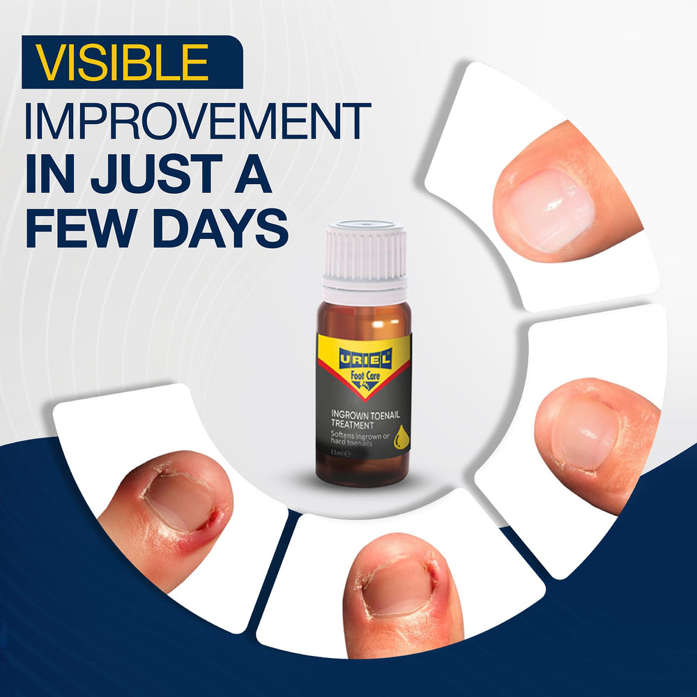 URIEL UPGRADED – Gouttes naturelles pour l'ongle incarné, application simple.