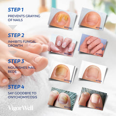 VigorWell skin-tone patch blends with nails for discreet fungal care