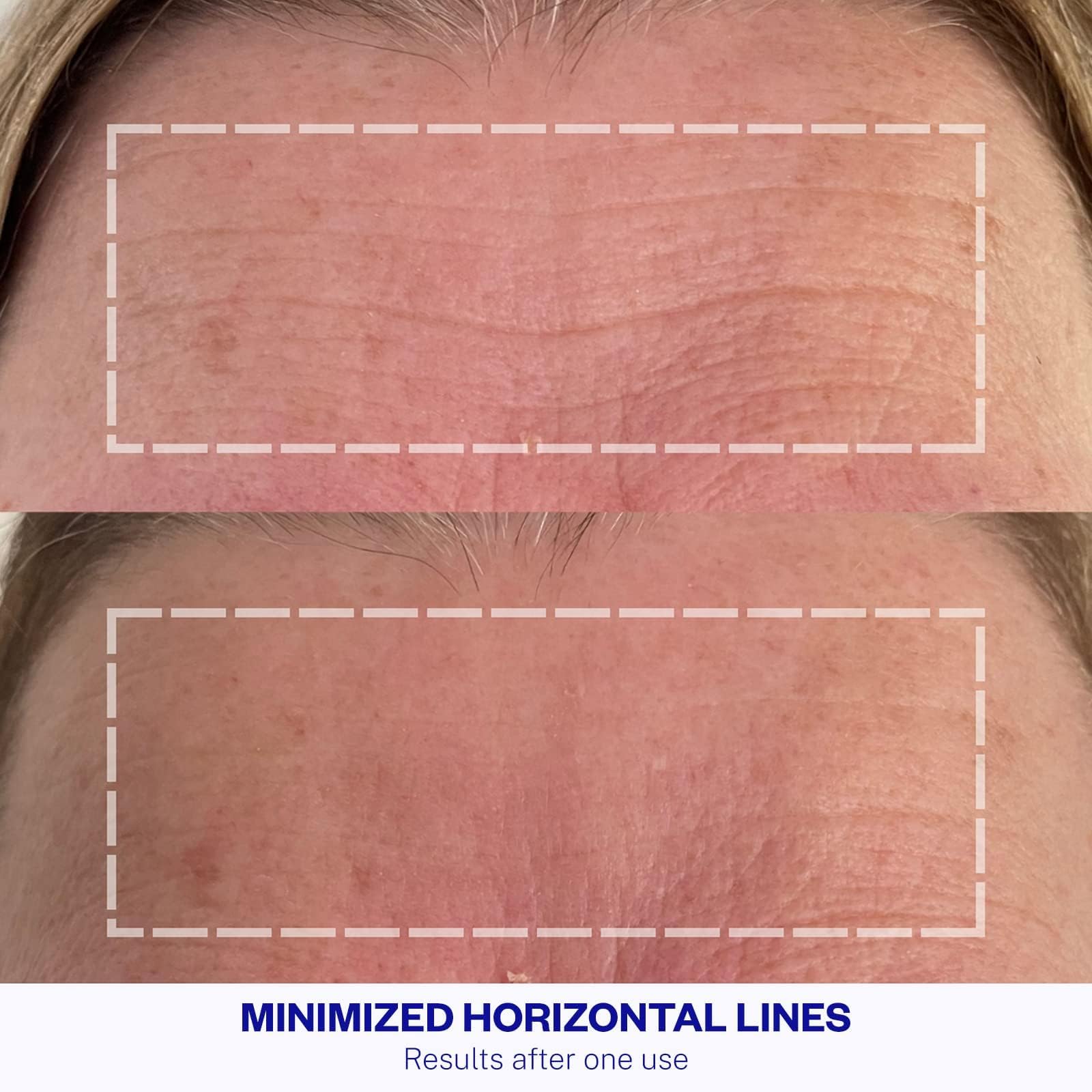Application simple des patchs Wrinkles Schminkles sur le front pour une peau lisse.