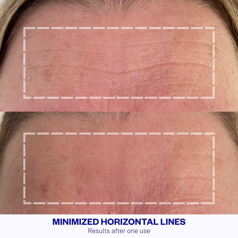 Application simple des patchs Wrinkles Schminkles sur le front pour une peau lisse.