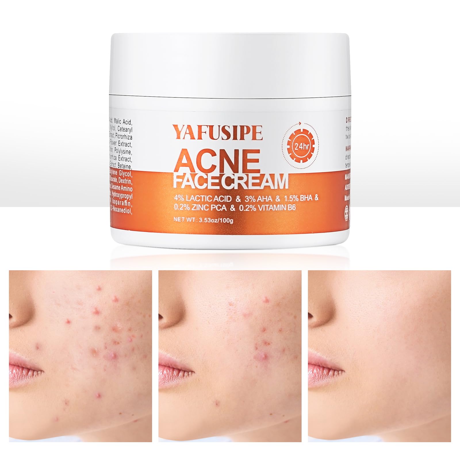 YAFUSIPE Soin acne visage: visage clair et zones ciblées.