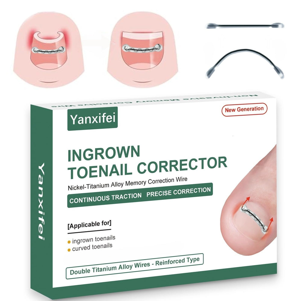 Yanxifei correcteur d’ongle incarné avec nitinol, soulage et redresse l’ongle progressivement.