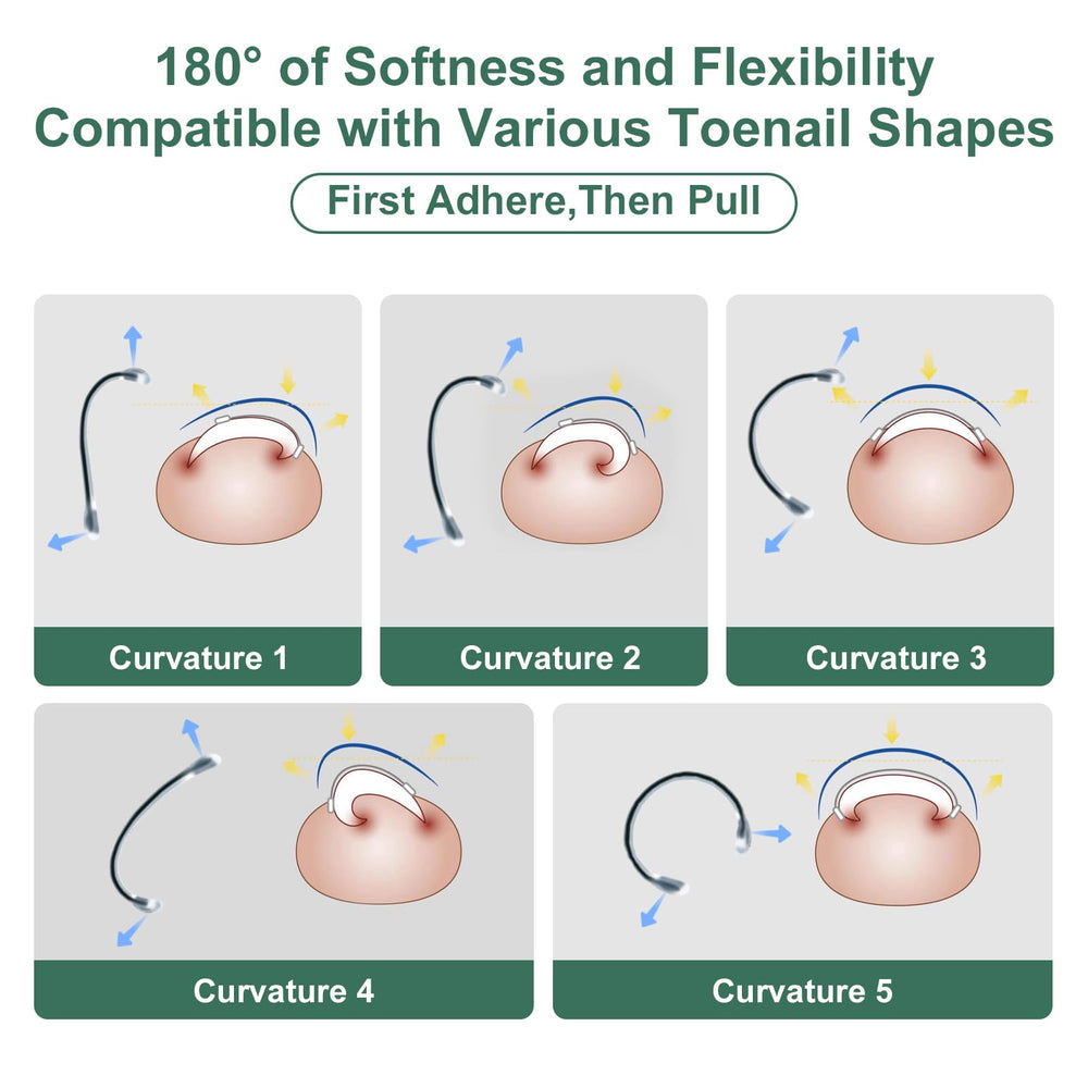 Yanxifei correction-double-fil, correction efficace pour ongles épaissis et profondément incarnés.
