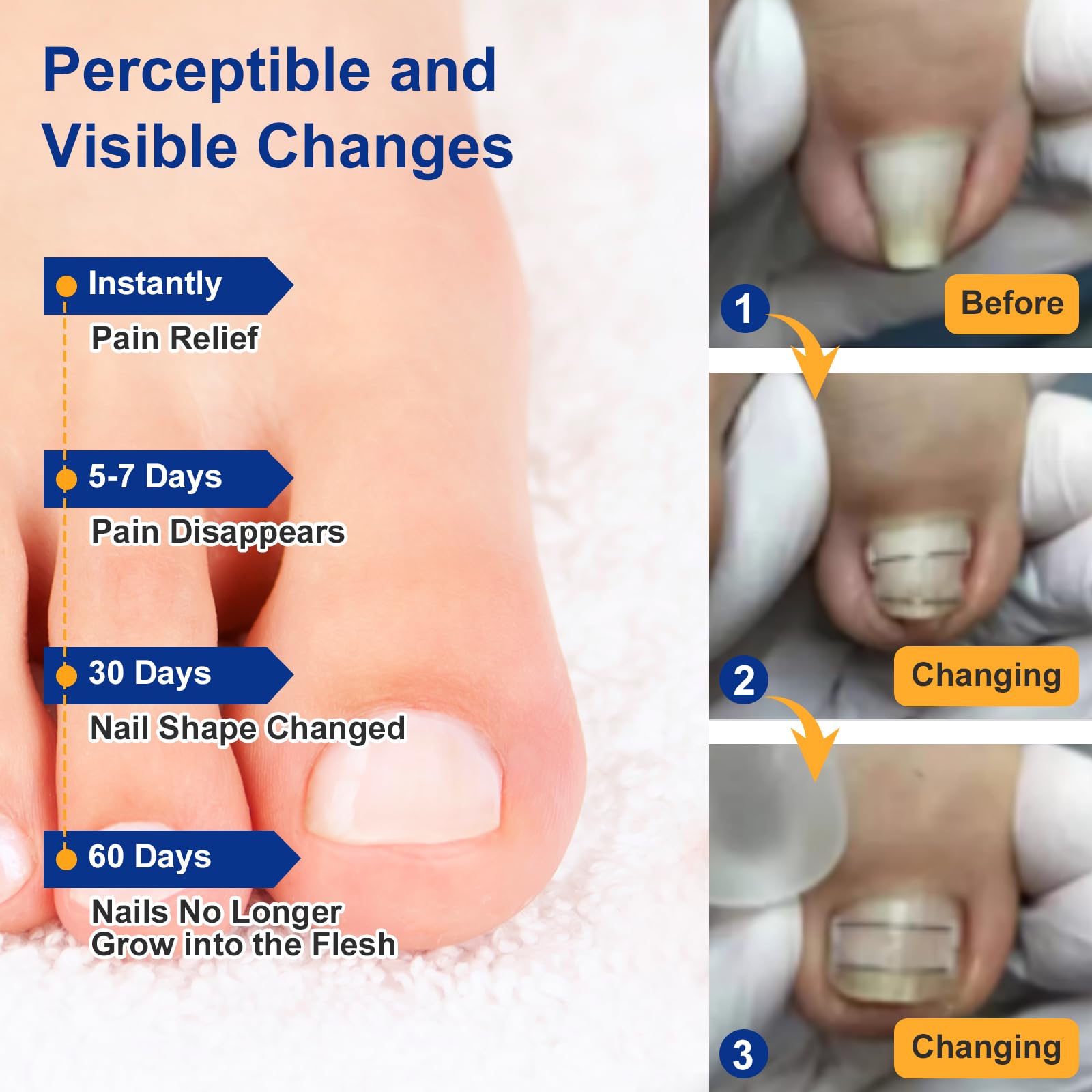 Yanxifei Kit traitement à domicile pour ongle incarné, tout-en-un