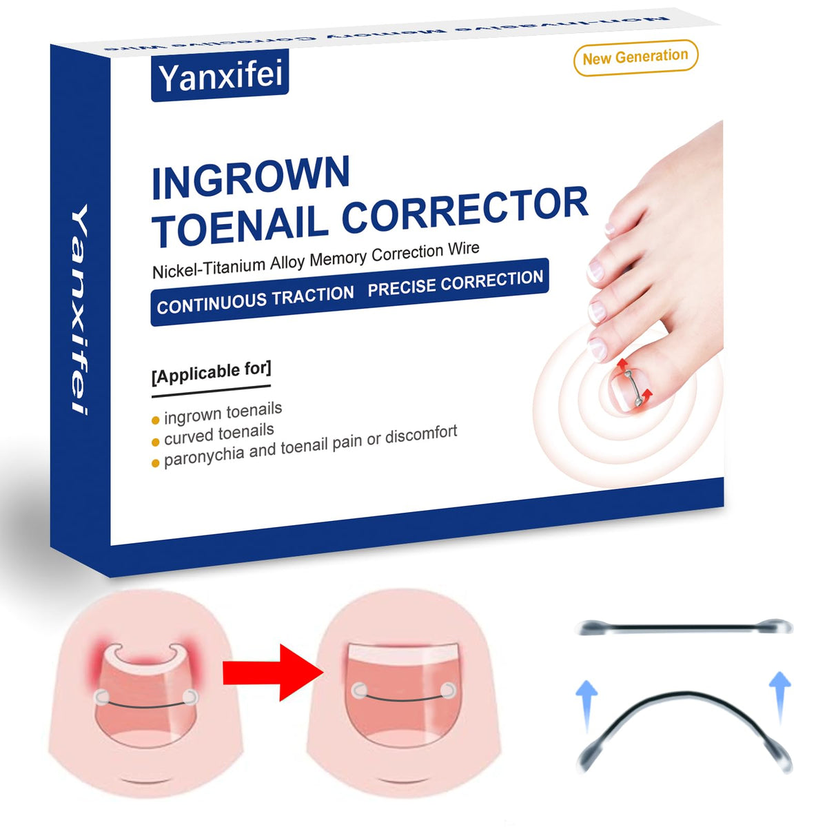 Yanxifei Correcteur Nitinol avant utilisation pour soulager l’ongle incarné