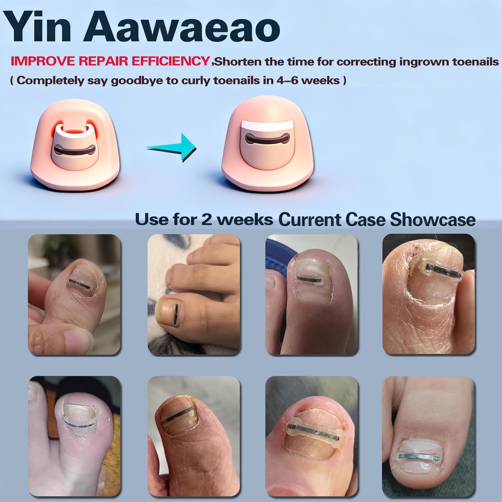Réutilisable Yin Aawaeao, kit ongle incarné prêt à l’emploi et sûr.