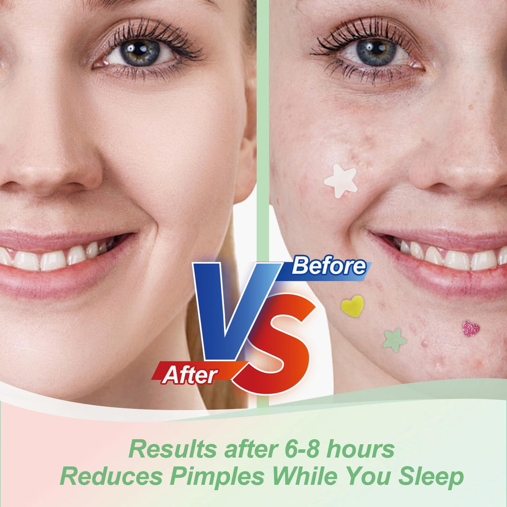 Patch hydrocolloide naturel YIWMWIY avec ingrédients apaisants.