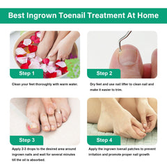 YOUVLAN séparateur ongle incarné - aide à l'alignement et au confort.