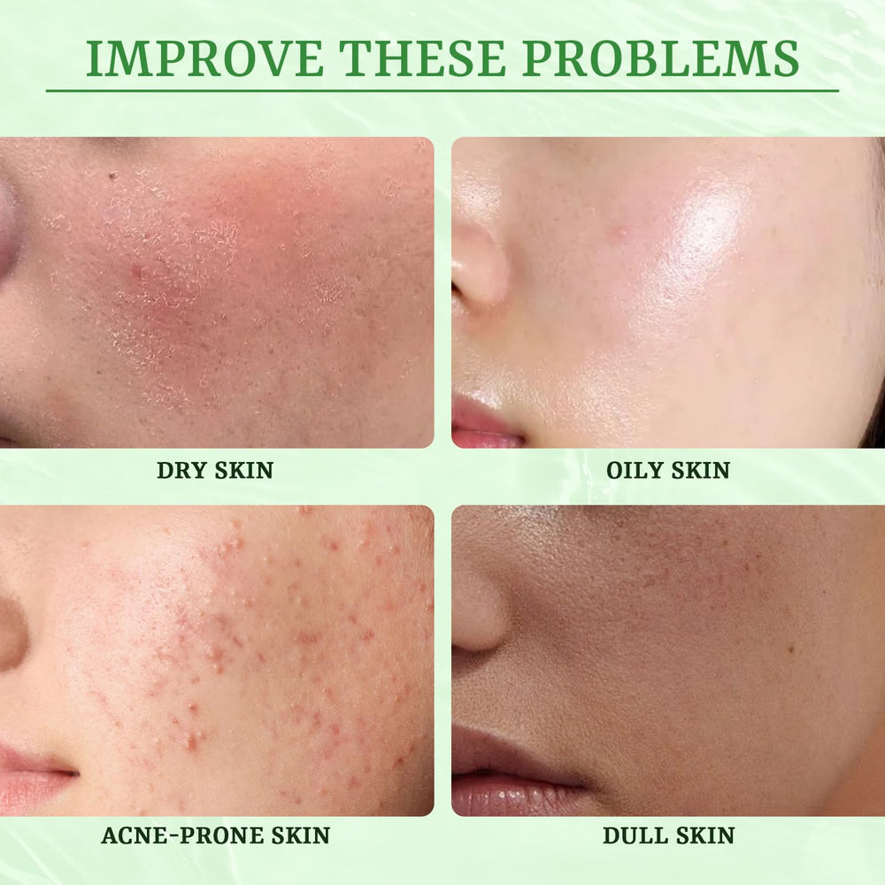 YTRAJU Masque anti-acne apporte une brillance naturelle et douce.