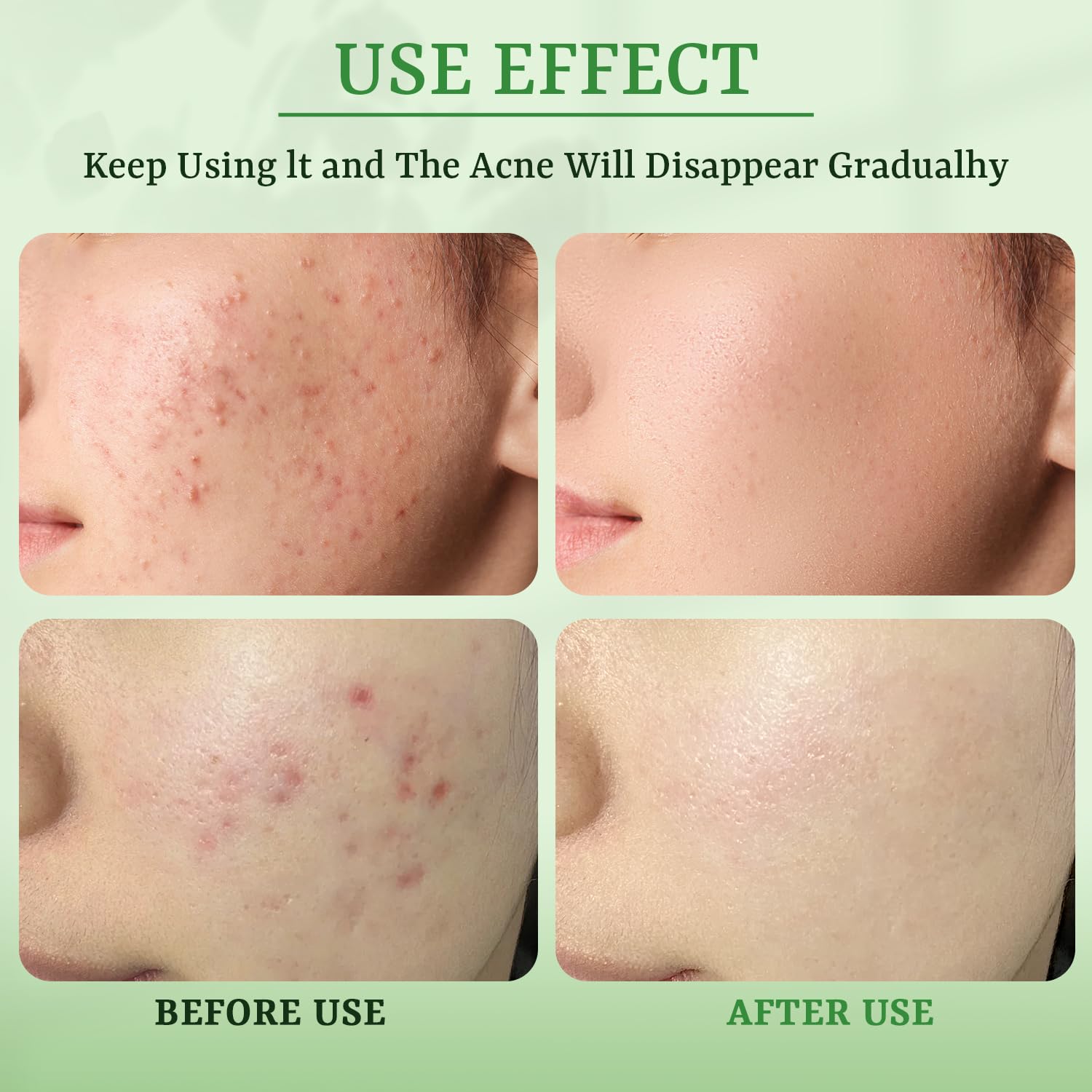 YTRAJU Masque anti-acne idee cadeau Saint-Valentin pour elle et lui.