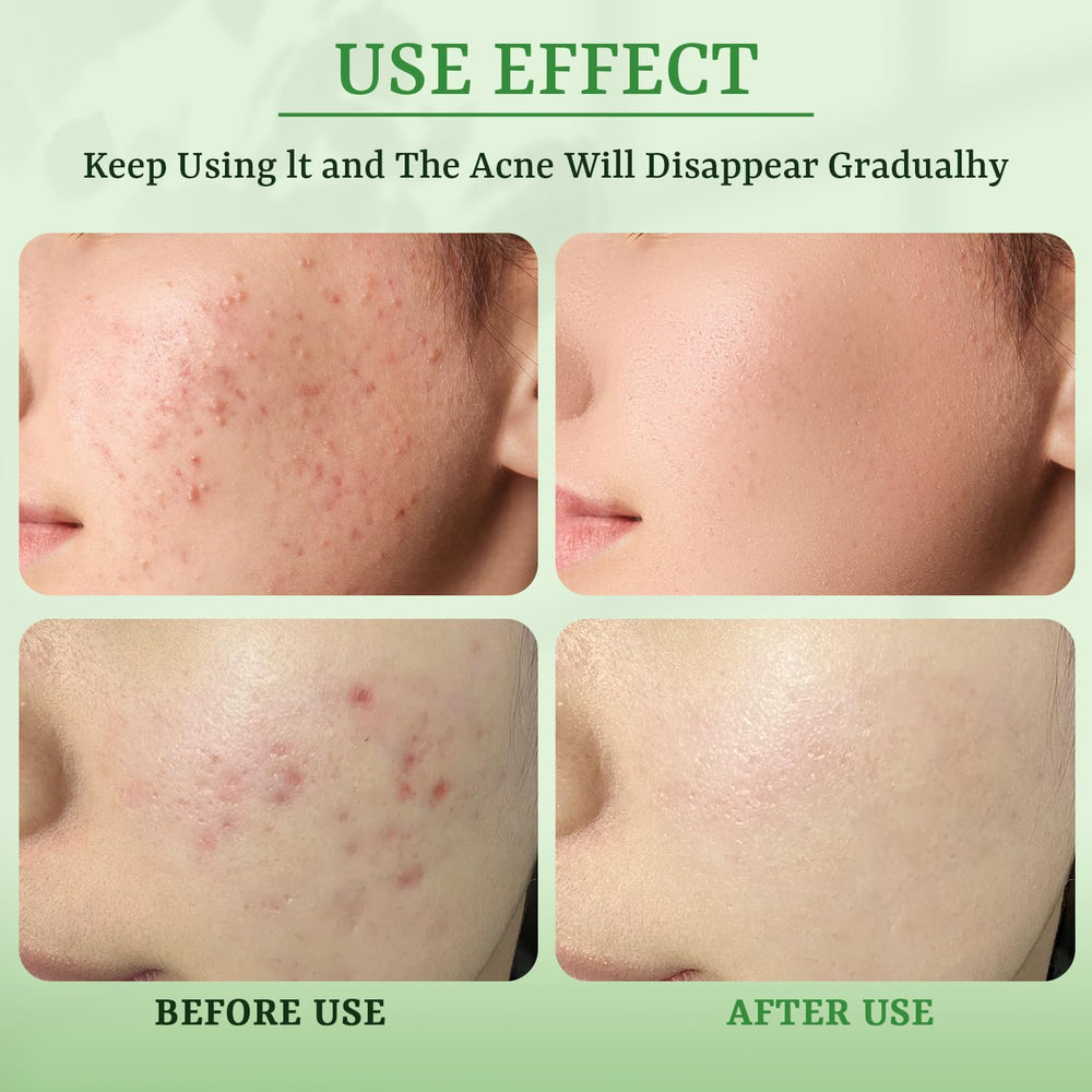 YTRAJU Masque anti-acne idee cadeau Saint-Valentin pour elle et lui.