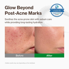 Application de la crème YUMU Cica Exosome sur peau sensible, sensation de fraîcheur.