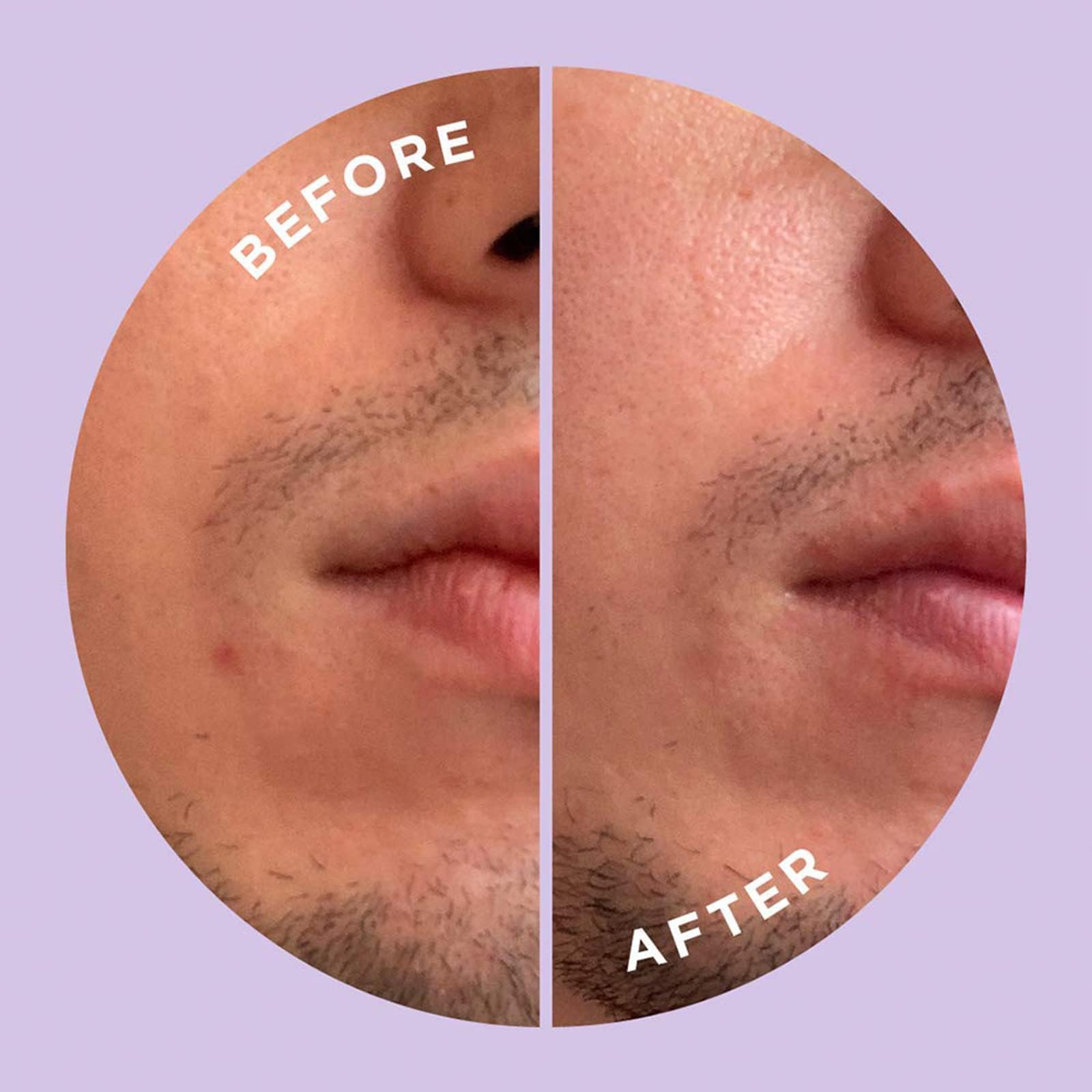 Pansement ZitSticka Hyperfade pour taches solaires et liées à l’âge, peau plus lisse.