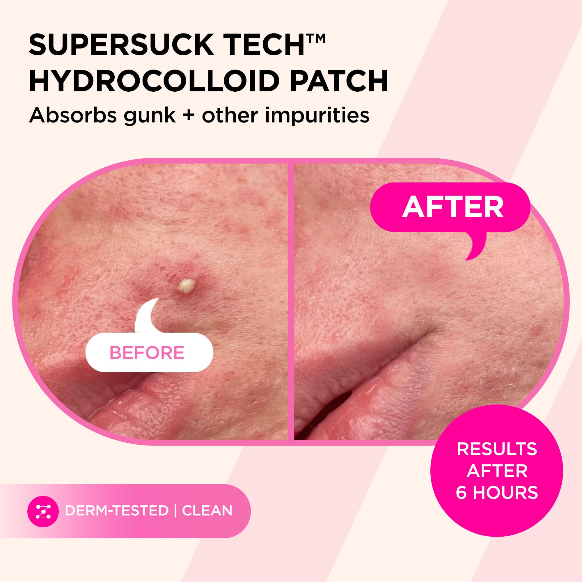Kit d'échantillons ZitSticka pour tester plusieurs solutions anti-imperfections.