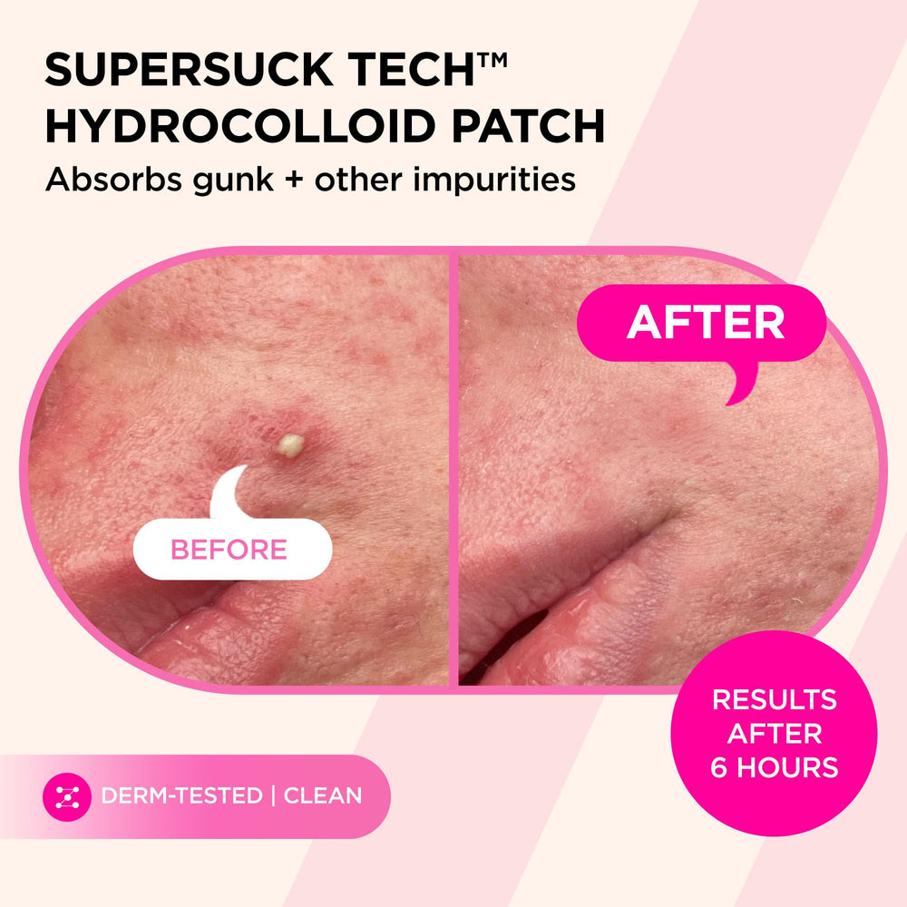 Kit d'échantillons ZitSticka pour tester plusieurs solutions anti-imperfections.