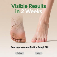 ZyraGloz Crème Urea 60% – pieds hydratés et peau plus douce.
