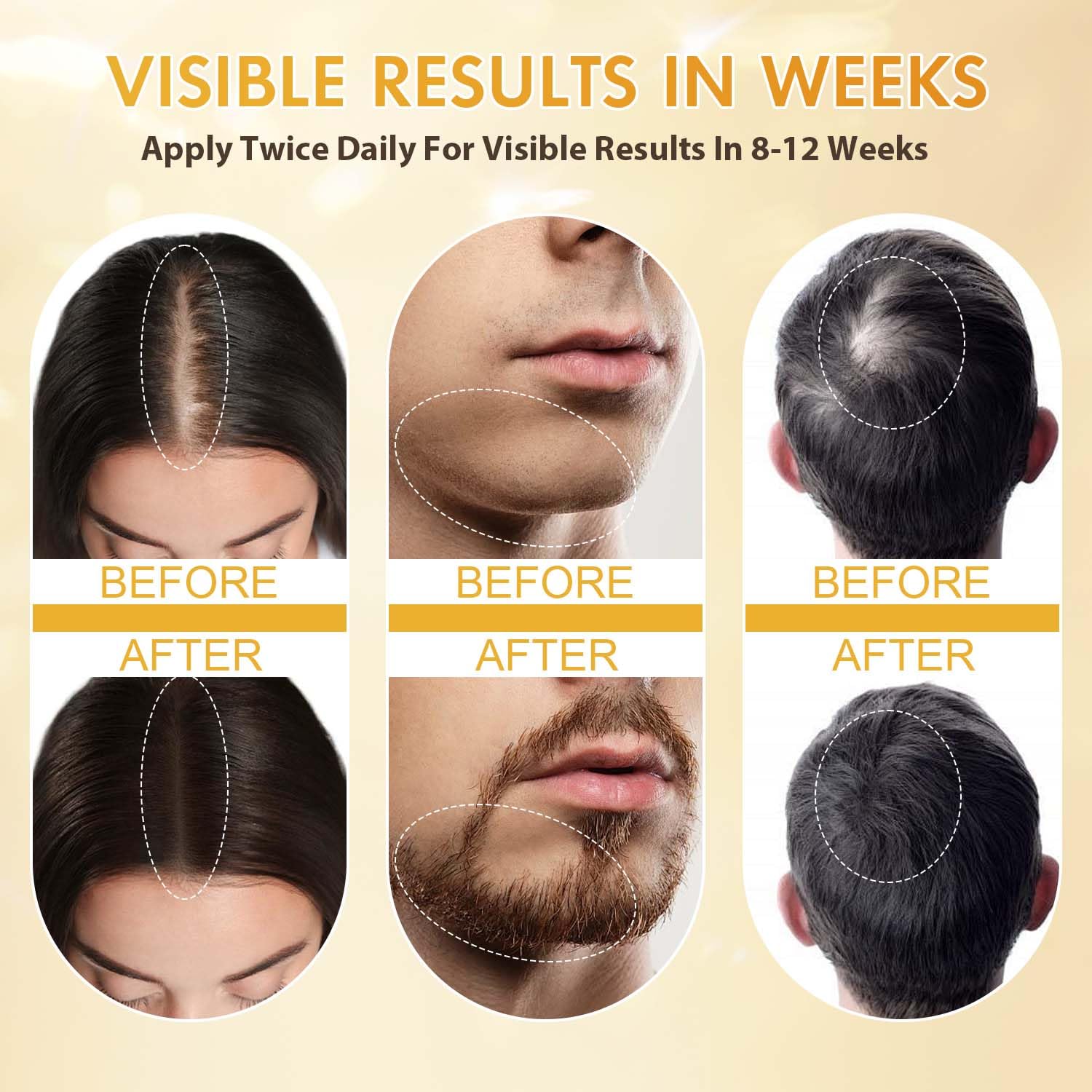 ZYXN Minoxidil - ingrédients romarin et batana mis en avant